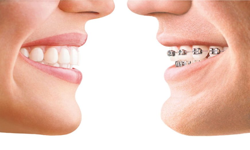 Budgeting for Invisalign: How to Manage Treatment Costs at Amma Naana Dental Clinic