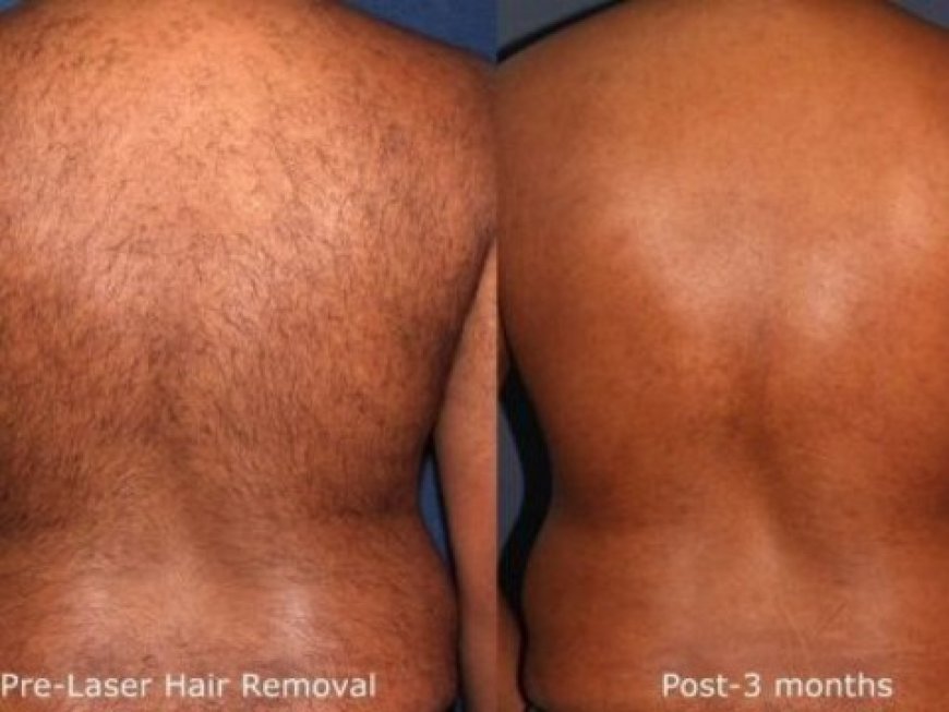 Say Goodbye to Unwanted Hair: Laser Hair Removal in North York