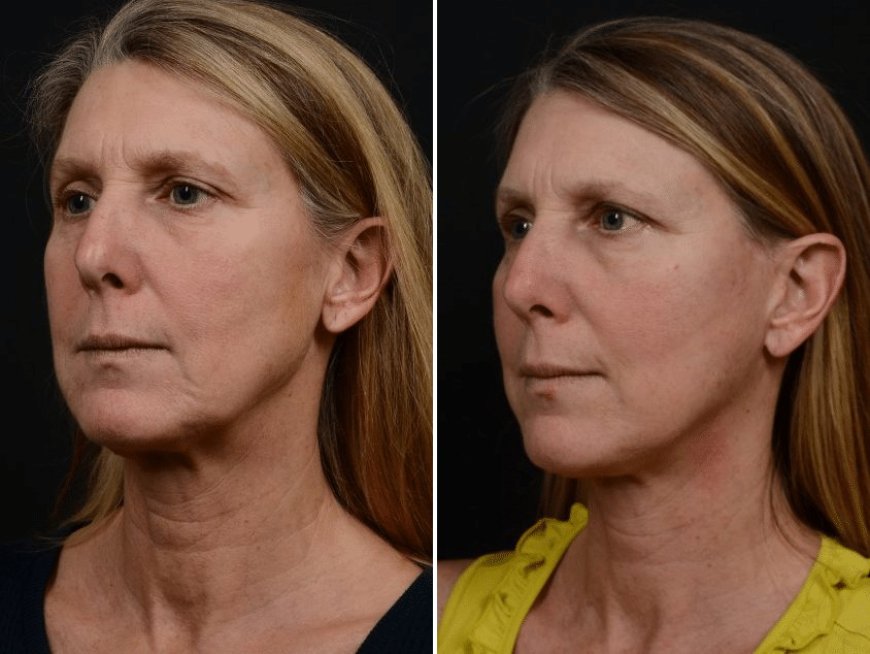 Longevity of Results from Mini Facelift Procedures