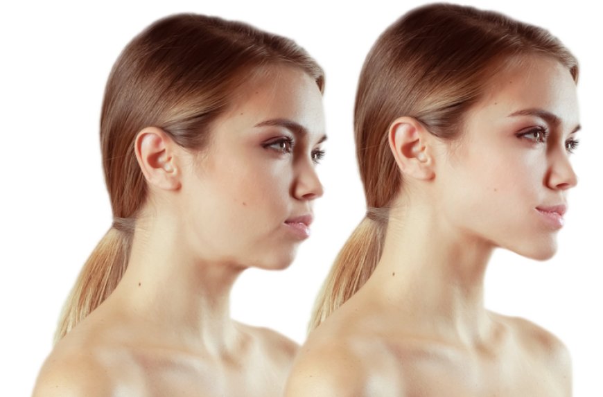 Preparing for Chin Liposuction Dubai Guidelines and Expectations