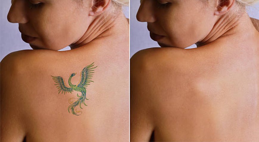 Uncover Clear Skin: Laser Tattoo Removal in Abu Dhabi's Secrets