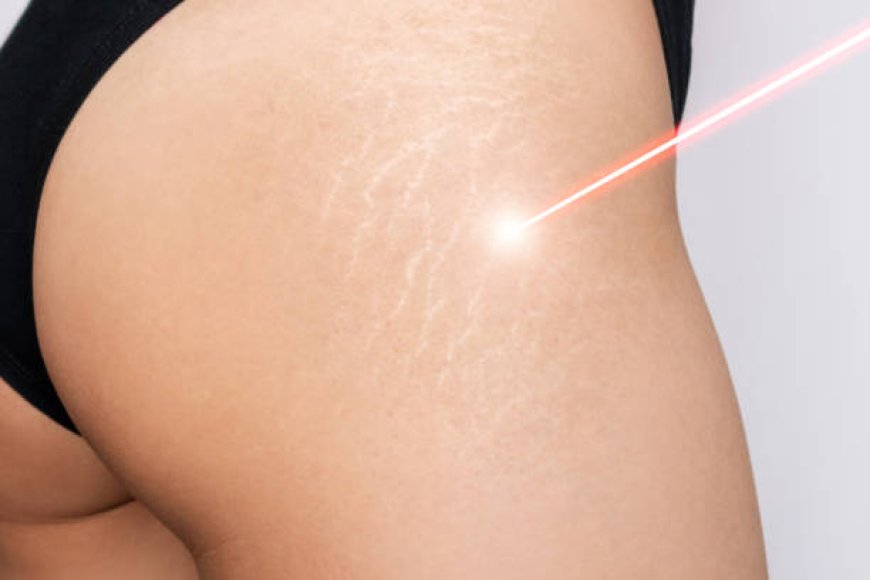 Uncover Clearer Skin: Stretch Marks Removal in Abu Dhabi