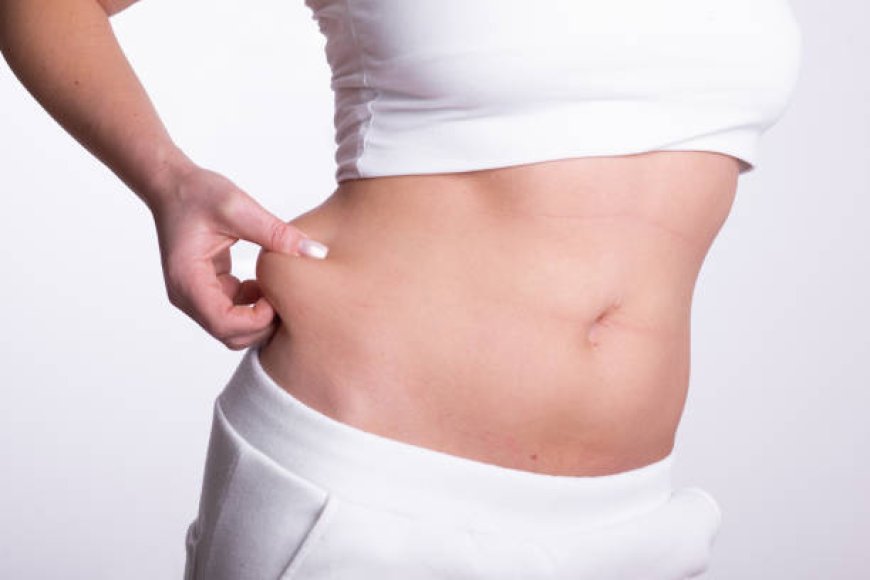 Liposuction Solutions: Abu Dhabi's Approach to Lipedema Treatment