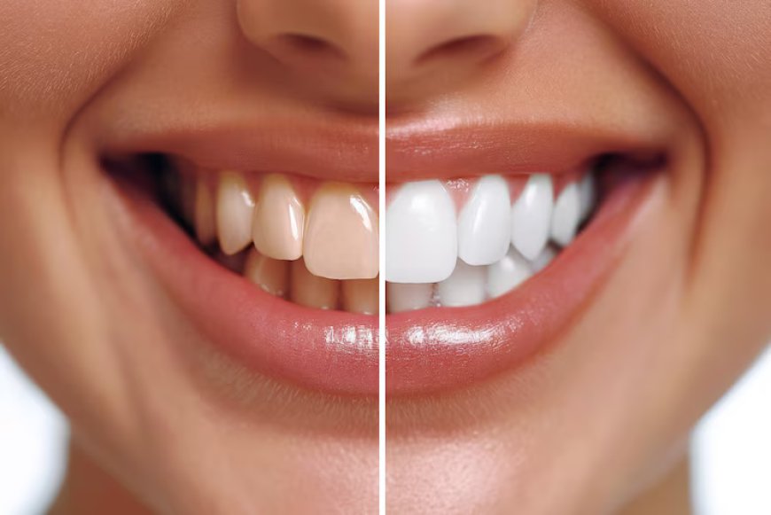 Achieving Radiant Smiles: The Journey of Teeth Whitening in Jasper, AL