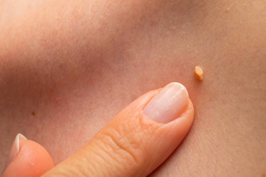 Mole-Free Skin Awaits: Mole Removal Treatments in Abu Dhabi