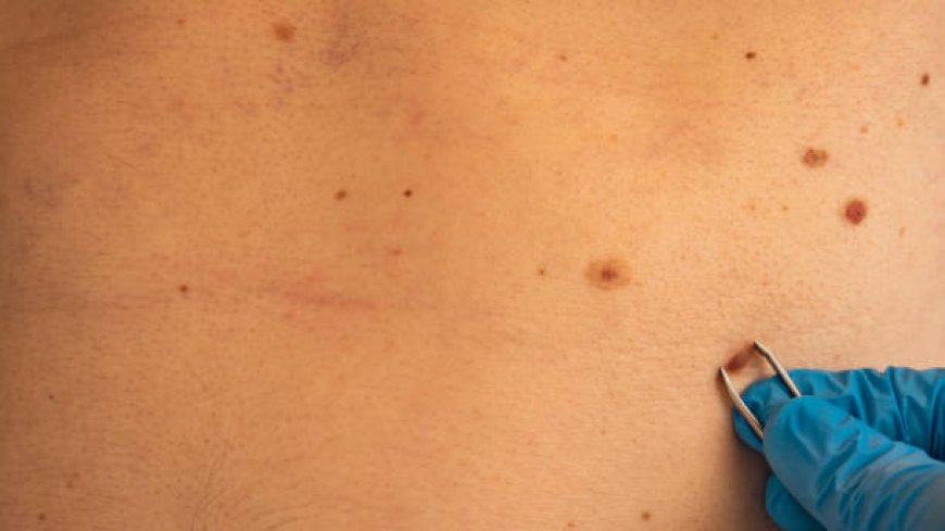 Safe and Effective: Laser Birthmark Removal in Abu Dhabi