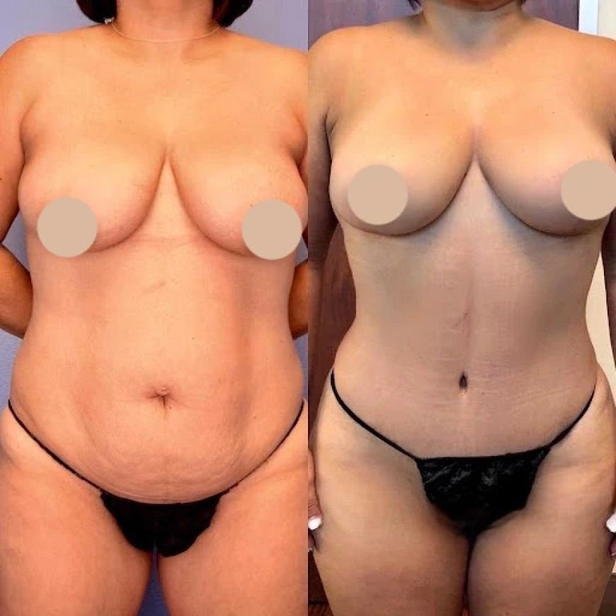 Exploring the Different Types of Tummy Tuck Techniques