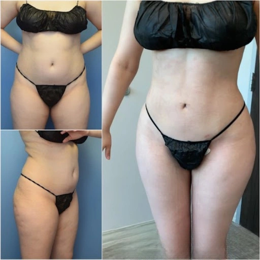 The Importance of Follow-Up Appointments After a Mini Tummy Tuck