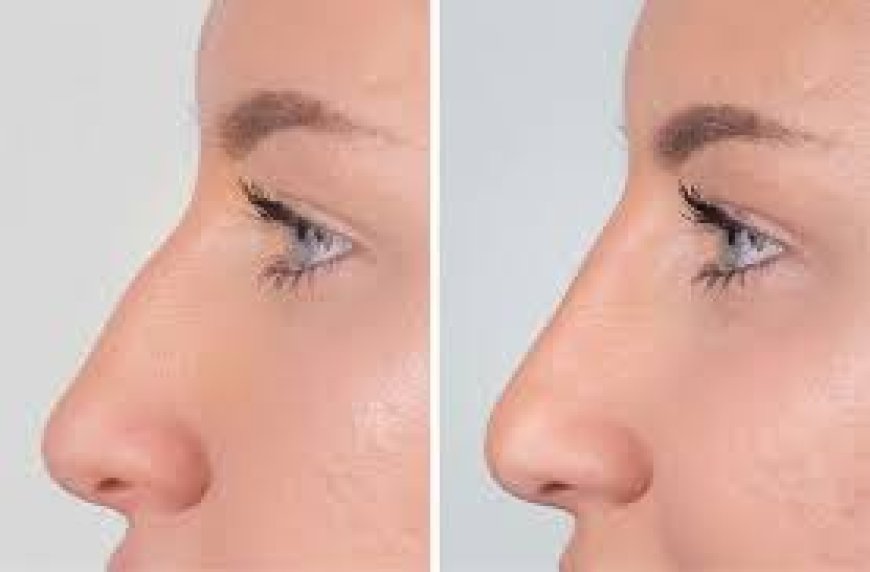 before and after care after taking Nose Bump Fillers