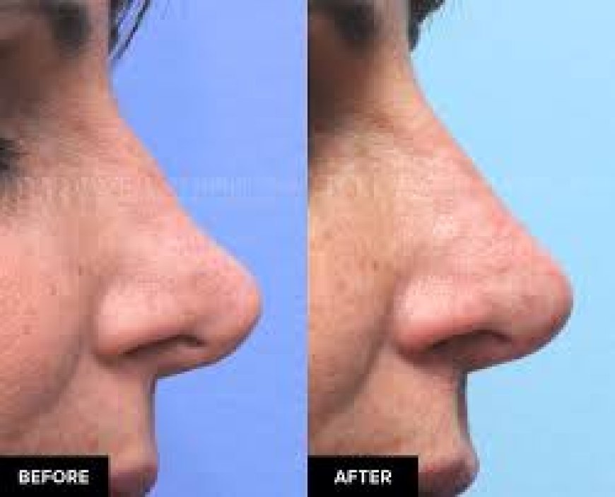 Cost Breakdown: How Much Does a Non-Surgical Nose Job Cost?