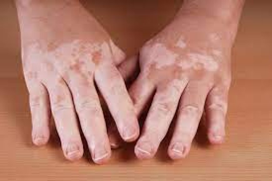 Riyadh's Topical Treatment for Vitiligo: Opzelura