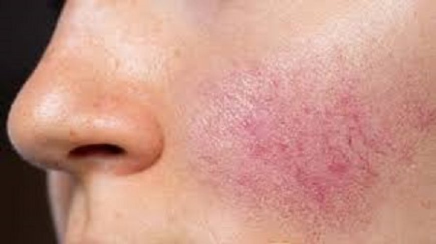 Expert Rosacea Care in Abu Dhabi: Find Relief