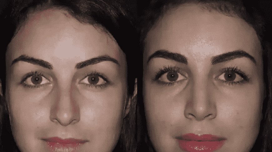 Rhinoplasty for Aging Faces: Addressing Changes in Nasal Structure Over Time in Dubai