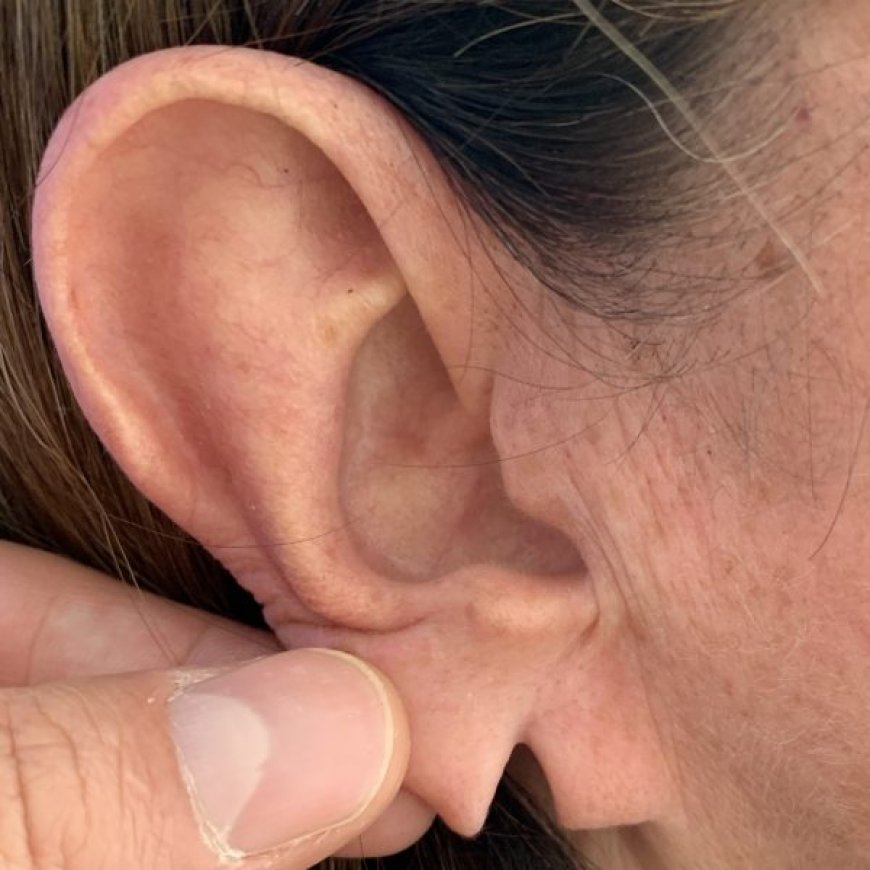 Step into Your Confidence: Earlobe Plastic Surgery in Riyadh