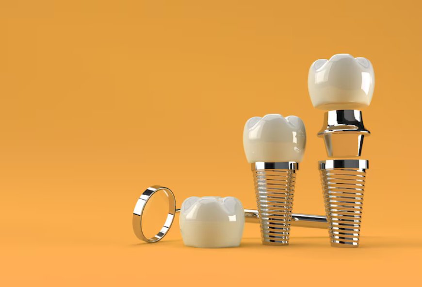 Dental Implants: Stability of the Dental Restoration