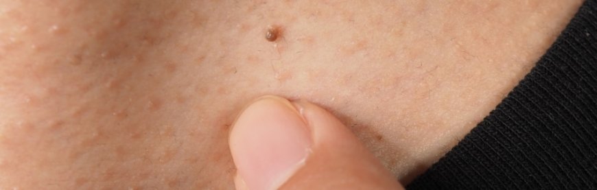 Skin Tag Removal Treatment: Say Goodbye to Unwanted Skin Tags