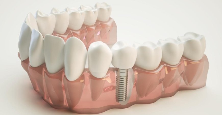 Understanding Dental Implant Costs in Tallahassee, FL