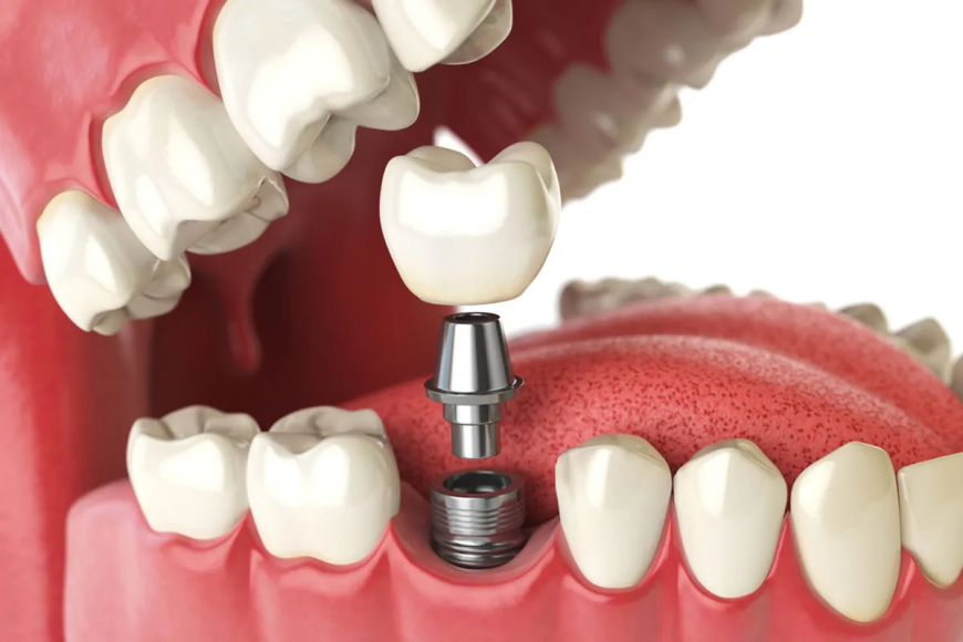 Regain Your Smile: Understanding Dental Implant Restoration