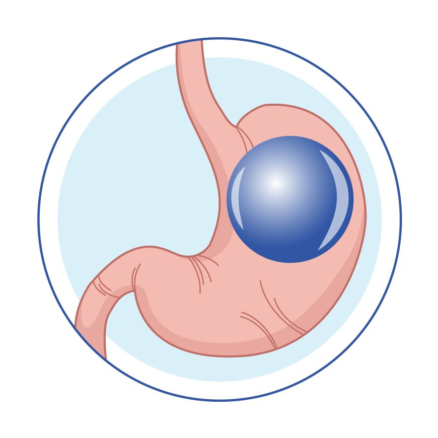 Comprehensive Gastric Balloon Care in Riyadh