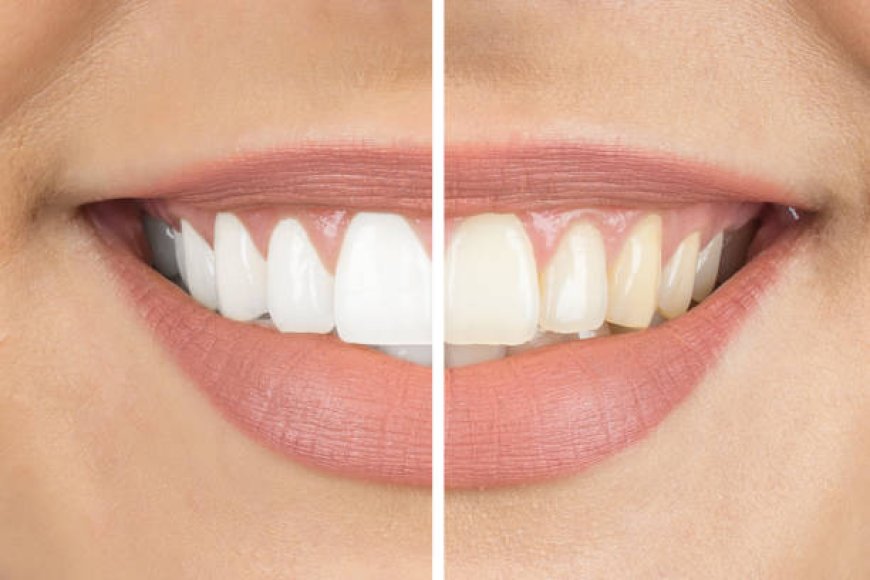 Explore Professional Teeth Whitening in Riyadh