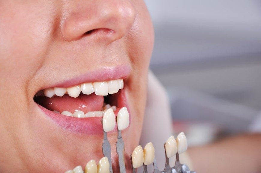 Transform Your Smile: The Magic of Dental Veneers