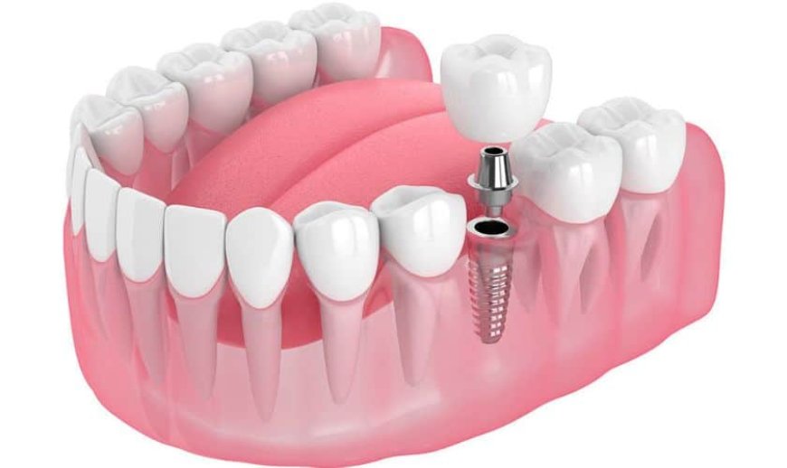 Implants: A Permanent Solution for Missing Teeth