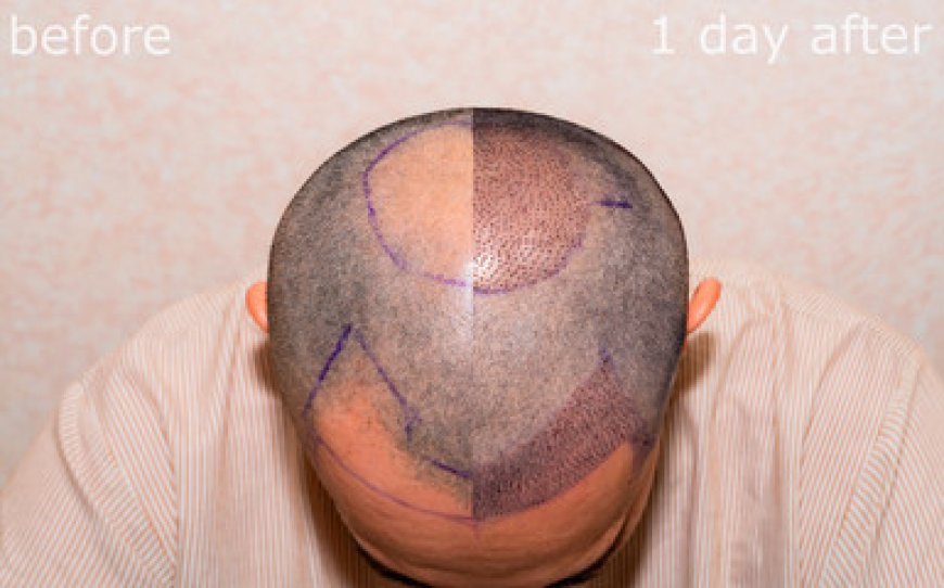 Boost Your Inner Confidence Through Hair Transplant Journey From Want Hair Ltd