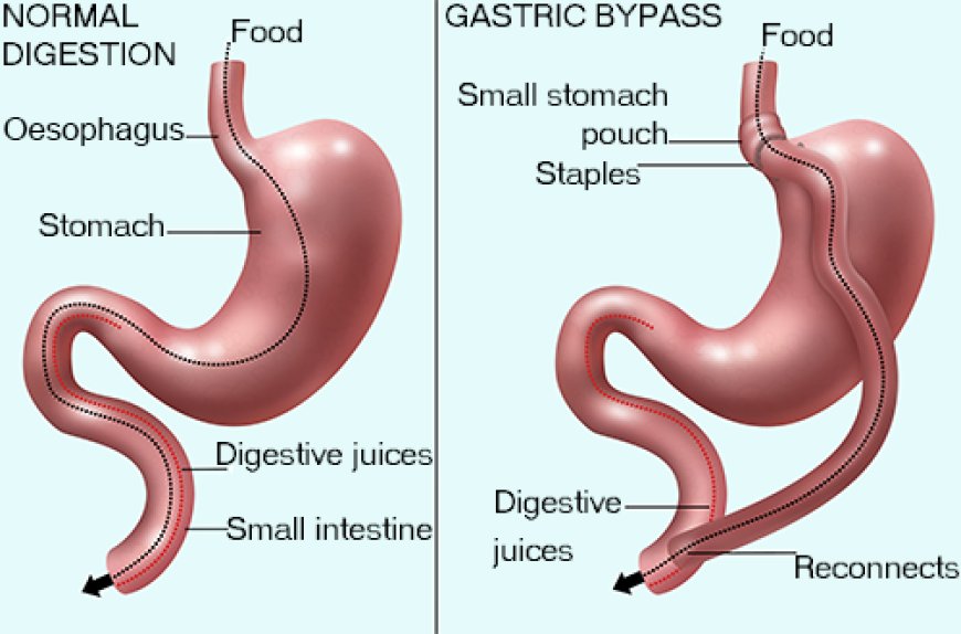 Leading Edge Weight Loss: Gastric Balloon in Riyadh