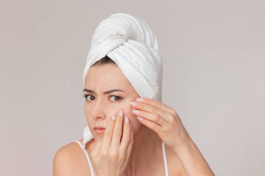 Acne Treatment in Abu Dhabi: Say Goodbye to Breakouts