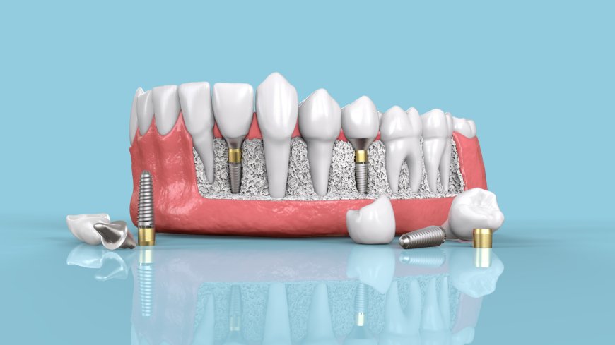 Affordable Dental Implants: Quality Care at the best Price