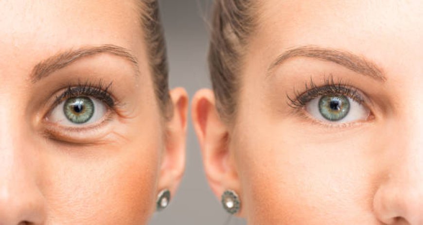 Eyelid Surgery in Abu Dhabi: Enhance Your Eye Contour Today