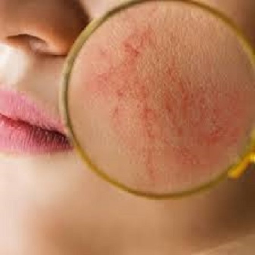 Natural Rosacea Relief: Abu Dhabi Treatment Options