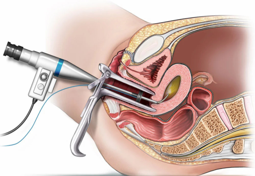 Top Hysteroscopy Treatment in Noida: What You Need to Know
