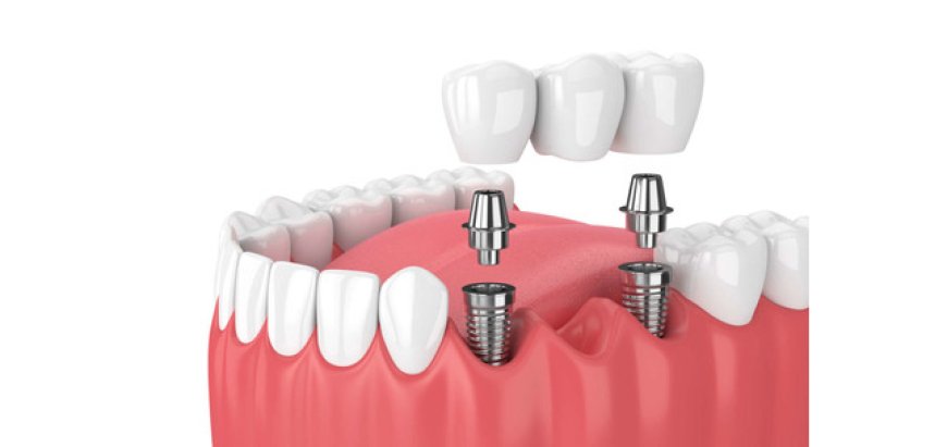 Recovering from Dental Implant Surgery: A Complete Guide