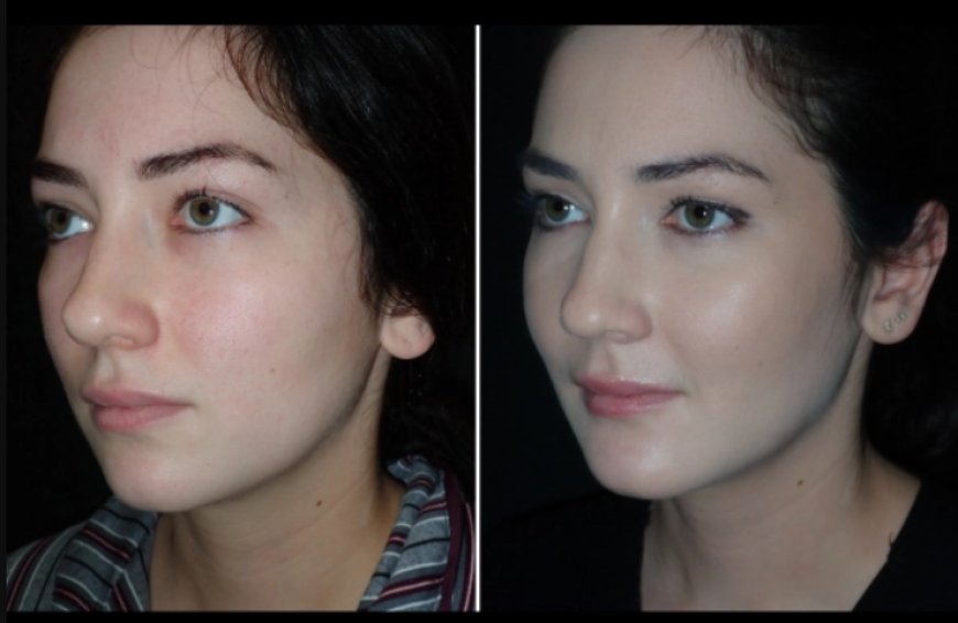 Restoring Youthful Volume with Facial Fat Transfer in Dubai