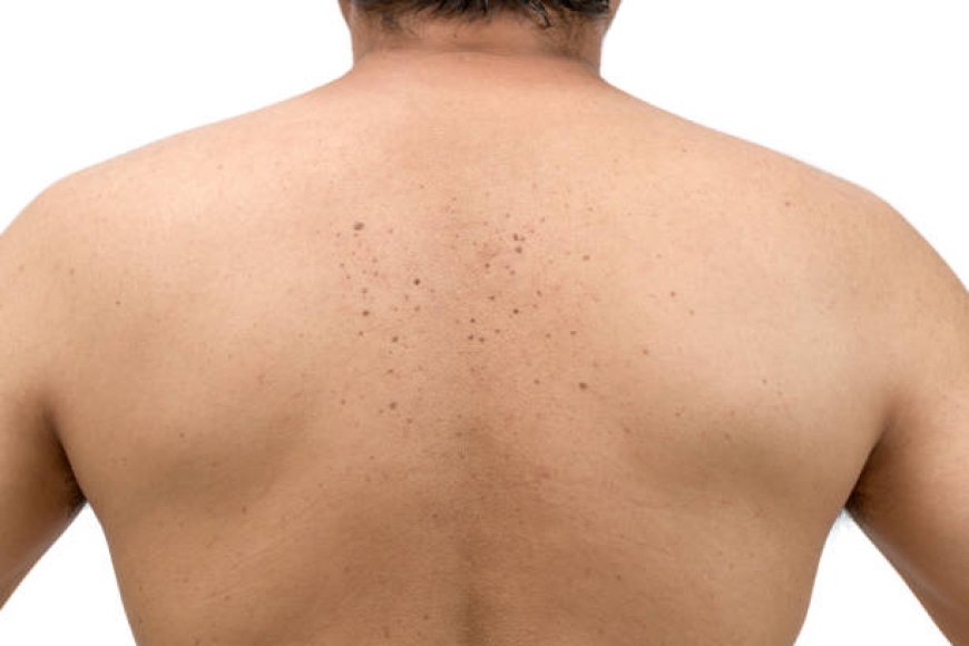 Seborrheic Keratosis Treatment in Abu Dhabi: Solutions for Every Skin Type