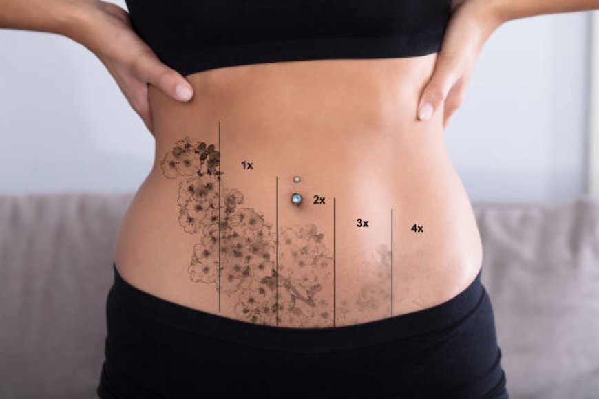 Laser Tattoo Removal in Abu Dhabi: Safe, Precise, and Effective