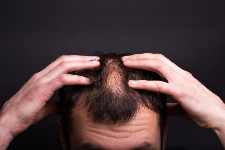 Want Hair Ltd: The Company That Provides Solutions for Male Hair Loss in the UK