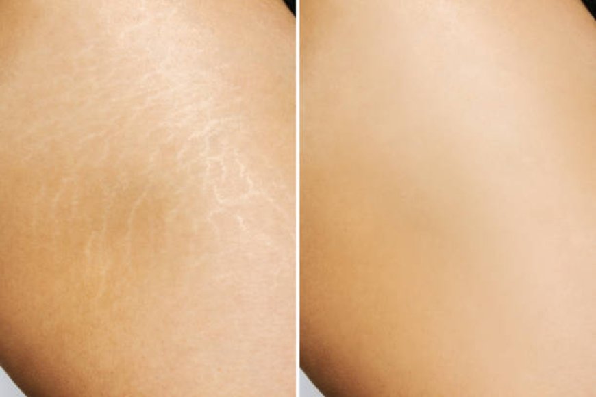 Expert Stretch Marks Removal in Abu Dhabi for Perfect Skin