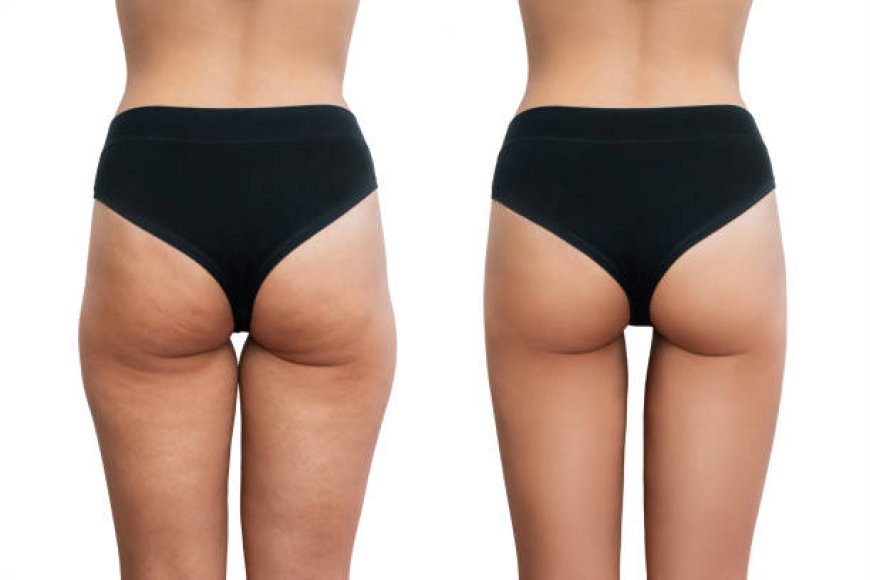 Cellulite Removal Treatment in Abu Dhabi: Achieve Silky Smooth Legs