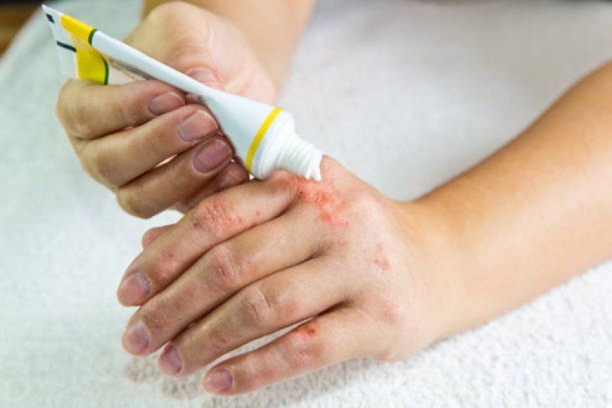 Expert Psoriasis Treatment in Al Ain: Restore Your Skin Health