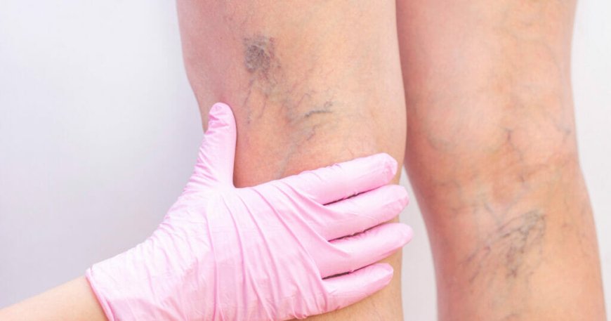 From Diagnosis to Cure: A Journey Through Varicose Veins Treatments