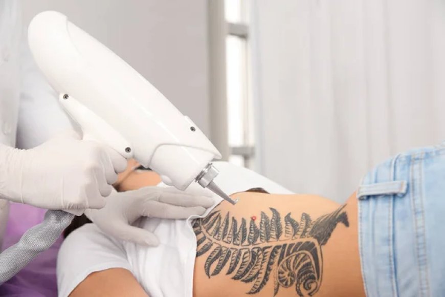 What to Know Before Your Laser Tattoo Removal