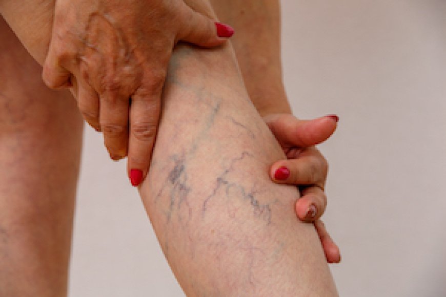 How to Achieve Beautiful Legs with Varicose Veins Treatments