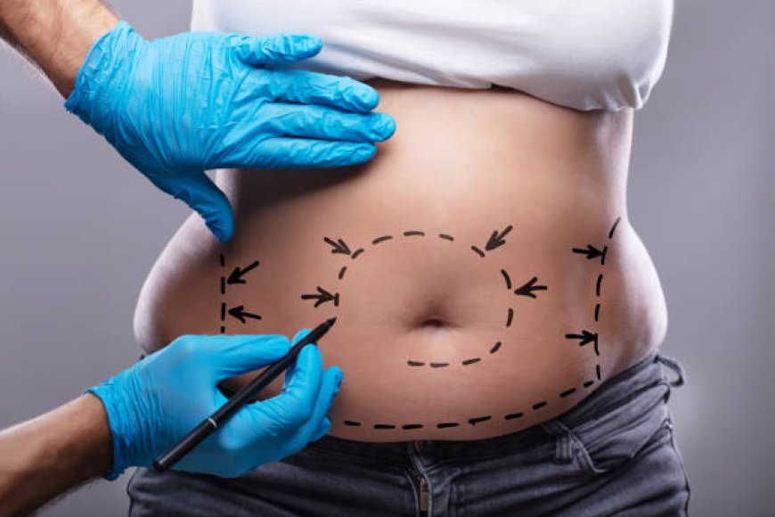 Redefine Your Silhouette with Liposuction Abu Dhabi