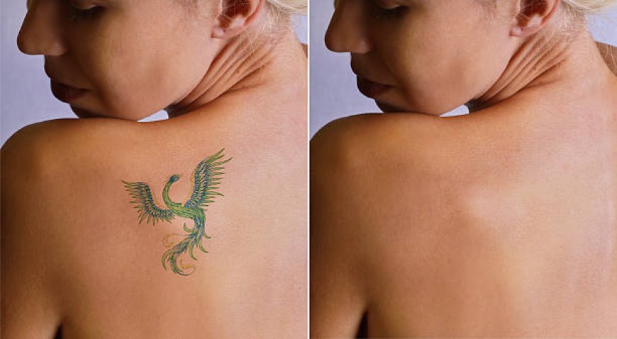 Erase Unwanted Ink with Laser Tattoo Removal in Abu Dhabi