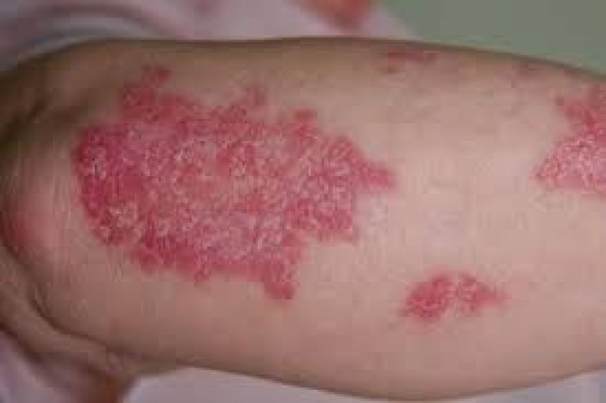 Psoriasis Treatment Trends: What’s New and What’s Proven to Work