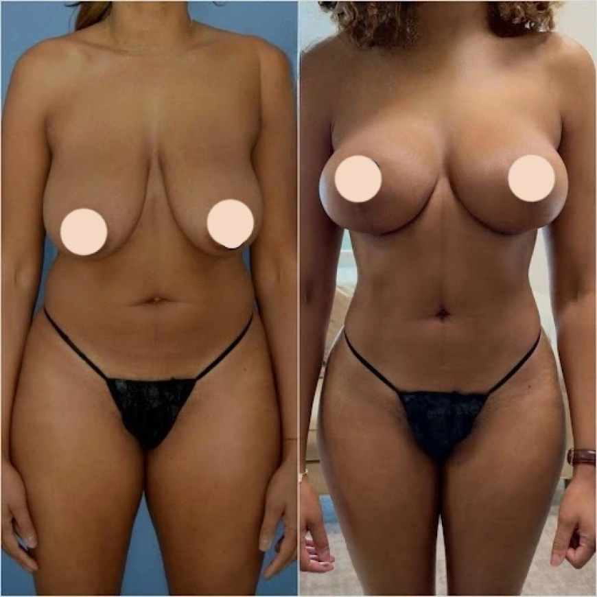 What to Expect During Your Body Contouring Consultation