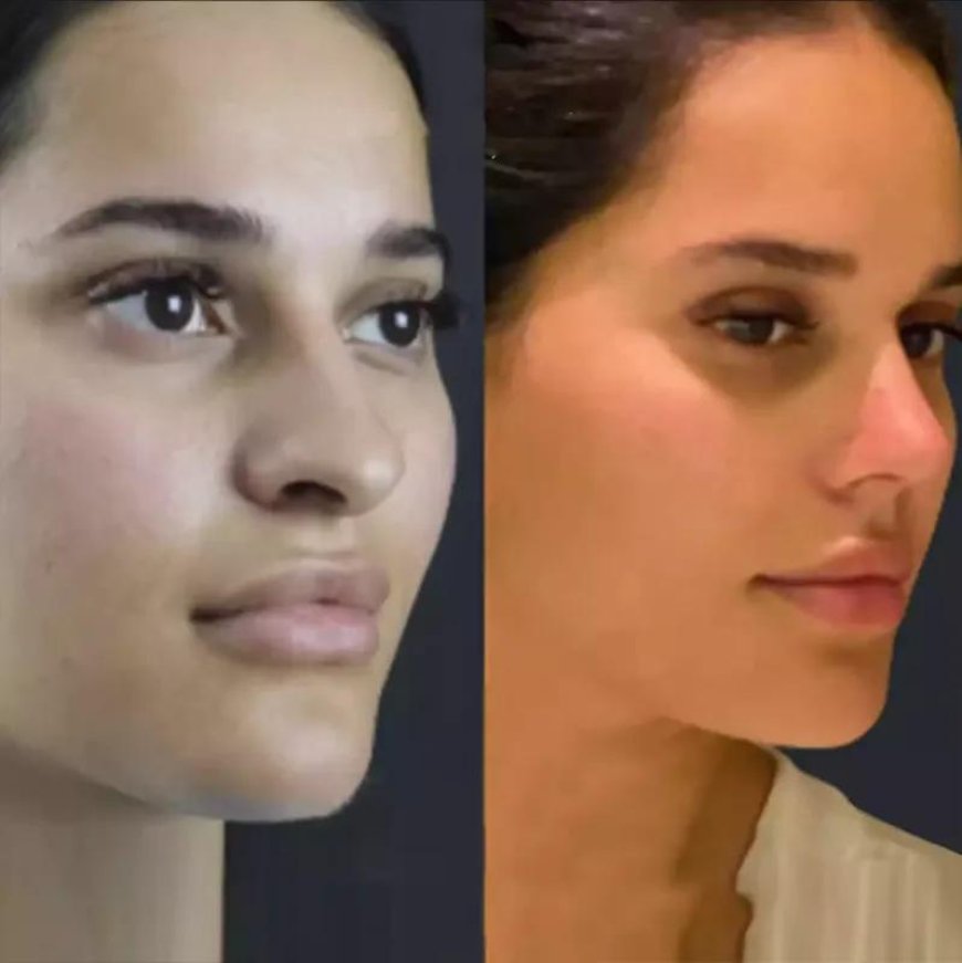 How to Deal with Swelling and Bruising After Rhinoplasty