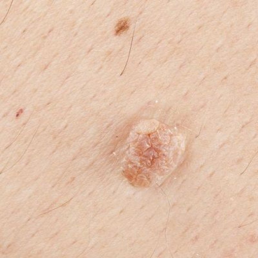 The Causes of Skin Tags and How to Remove Them in Dubai